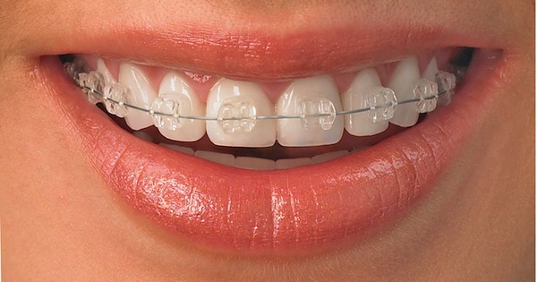 orthodontie, invisible, esthétique, bagues céramiques