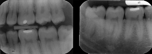 orthodontie, adulte, radiographies rétro-alvéolaires, radiographies rétro-cornaires