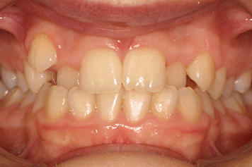 orthodontie photographie malposition canine