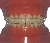 orthodontie, appareil multi-attaches, appareil multi-bagues, céramique, orthodontie esthétique