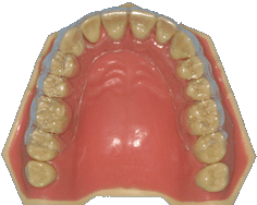 orthodontie, appareil amovible, gouttières, aligneurs, orthodontie esthétique, orthodontie invisible