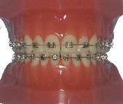 orthodontie, appareil multi-attaches, appareil multi-bagues, métal