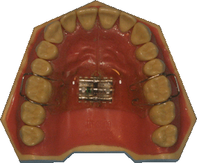 orthodontie, appareil amovible, plaque à vérin, gouttières, aligneurs, orthodontie esthétique, orthodontie invisible